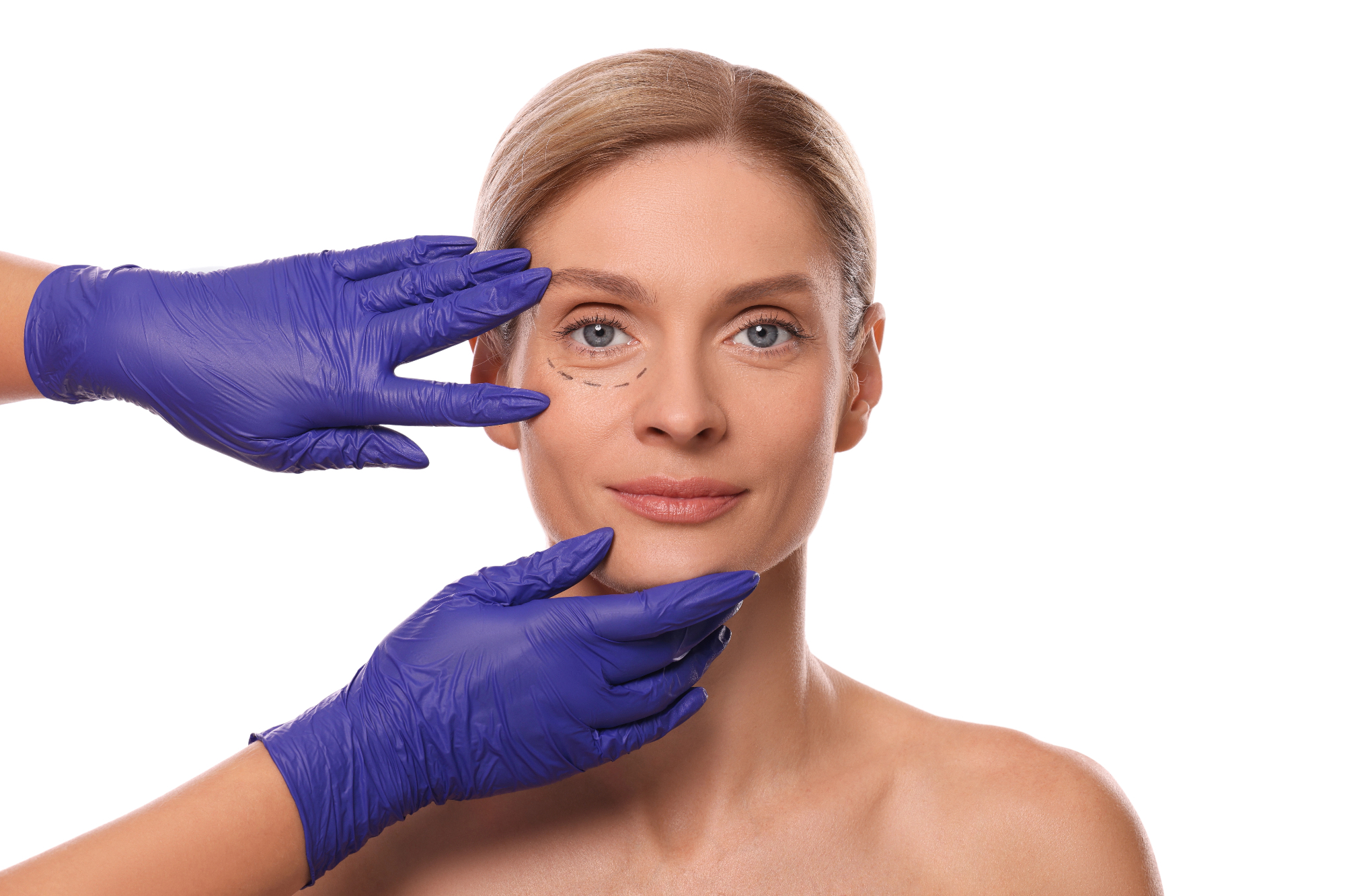 Blefaroplastika je ena najboljših odločitev, kar sem jih sprejela zase.